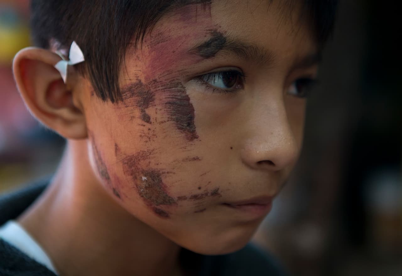 Josué Tolentino Gómez, de 11 años, es un sobreviviente del terremoto. Estuvo sepultado en Juchitán, Oaxaca.