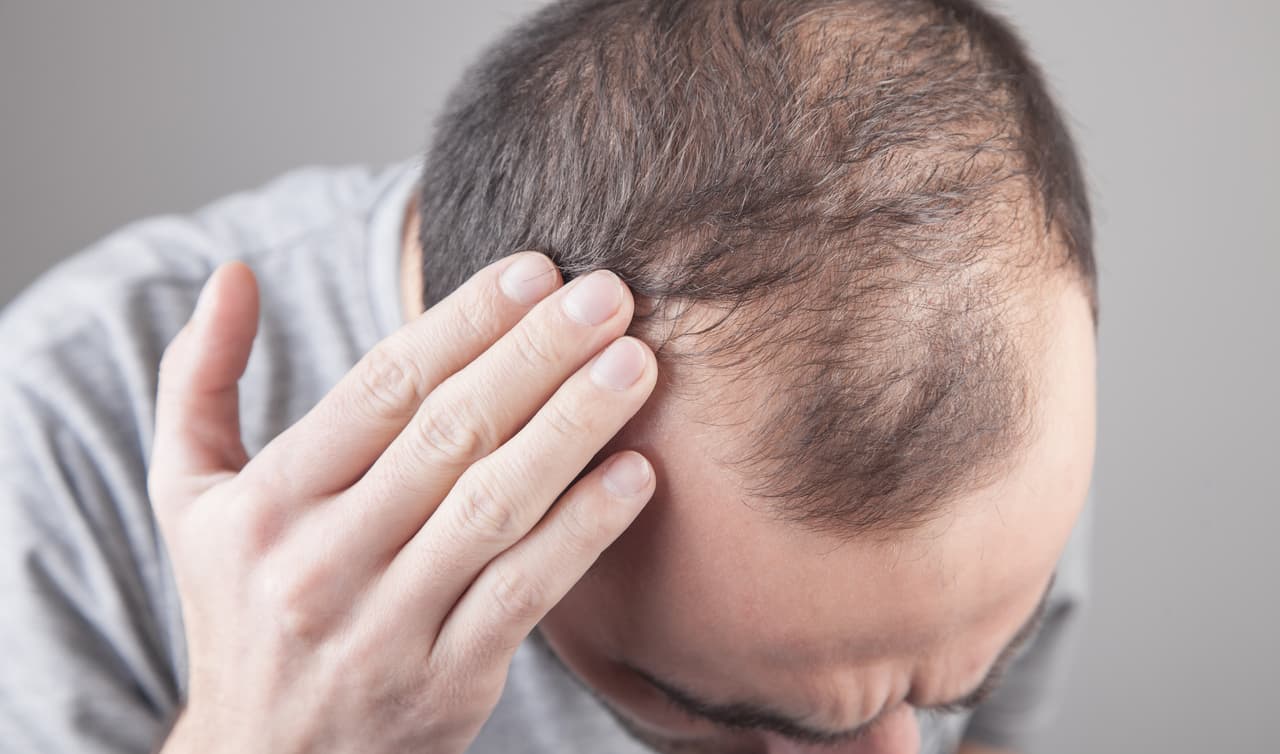 Alopecia severa: FDA aprueba la primera pastilla para restituir el cabello 