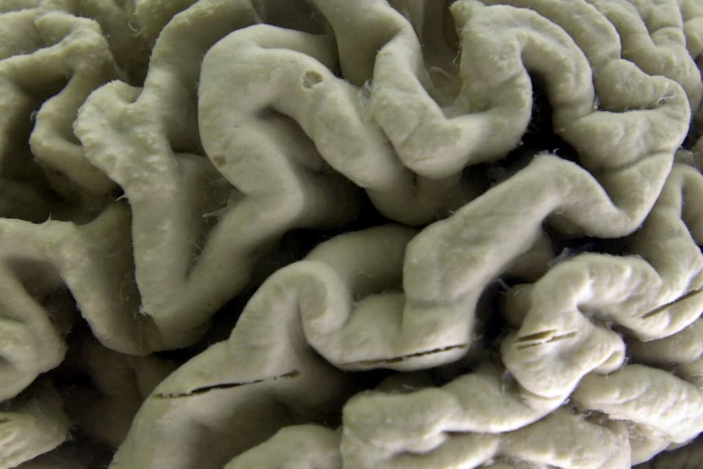 Identifican una nueva forma genética del mal de Alzheimer 