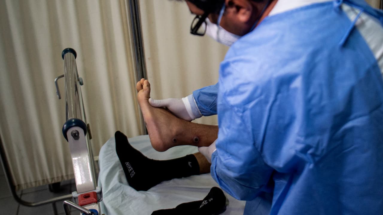 Este lunes los Centros para el Control y la Prevención de Enfermedades confirmaron la muerte de una persona a causa de la viruela del mono. El paciente de Los Ángeles se encontraba severamente inmunocomprometido. 
<a href="https://www.univision.com/noticias" target="_blank">Sigue las últimas noticias en Univision. </a>