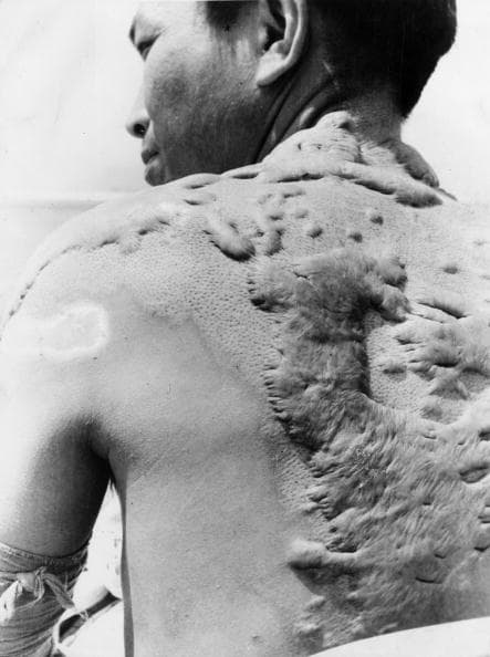 Víctima de la bomba atómica de Hiroshima