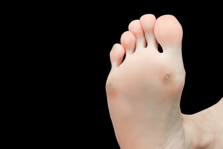 Si esa herida no se trata a tiempo o no sana bien, es posible que se infecte y si eso llegara a complicarse, existe la posibilidad de que haya que amputar esa parte del cuerpo (el dedo, o el pie) para evitar que la infección se esparza a otras zonas.
<br>