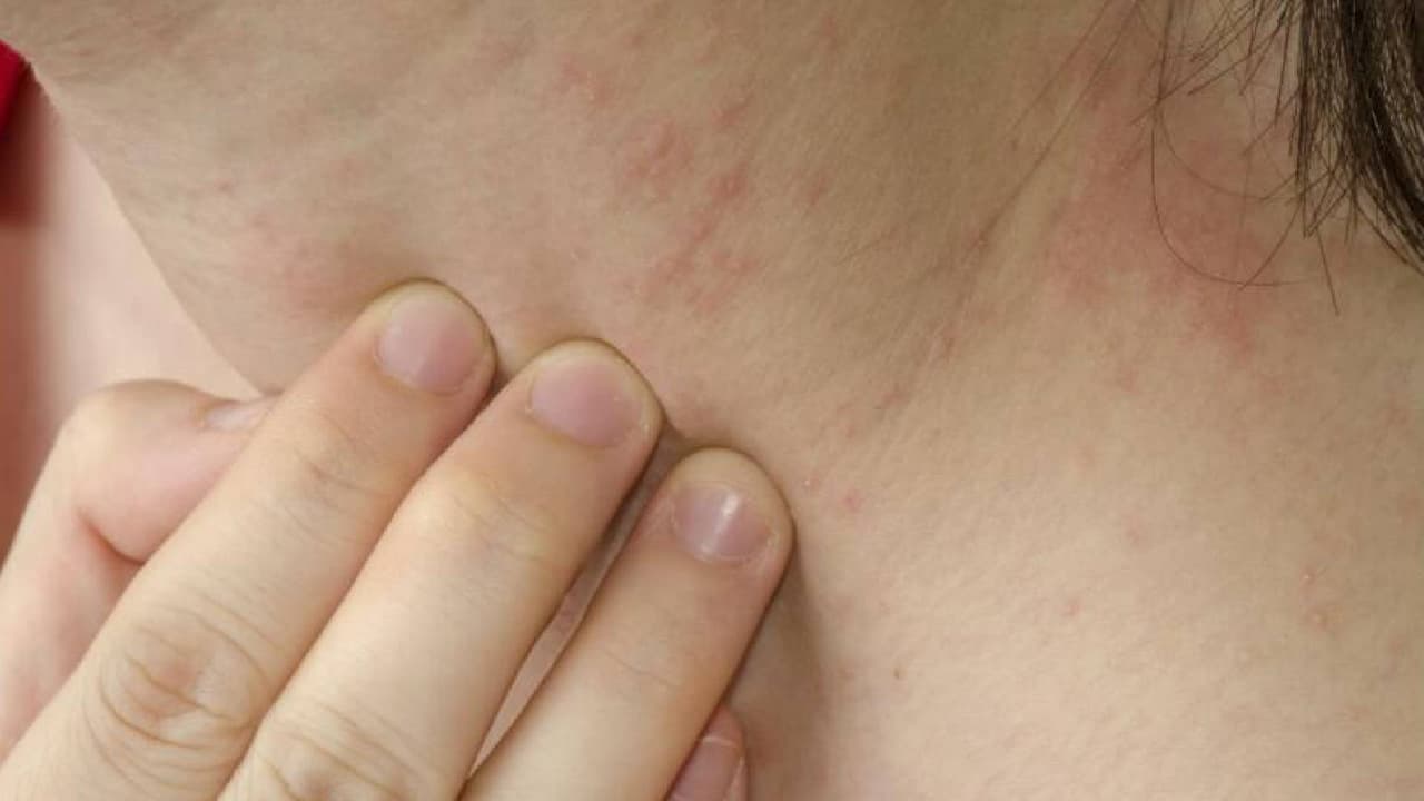 <b>¿Cómo saber si he sido mordido por una chinche?</b>
<br>Es difícil saber si le ha picado una chinche, ya que inyectan un anestésico y un anticoagulante que impide que la persona se dé cuenta de que está siendo picada. Sin embargo, 
<b>su mordida provoca marcas similares a la picadura de un mosquito</b>, dejando el área ligeramente hinchada y enrojecida, en algunas personas la picadura puede pasar desapercibida, pero en otras puede provocar molestias mayores.