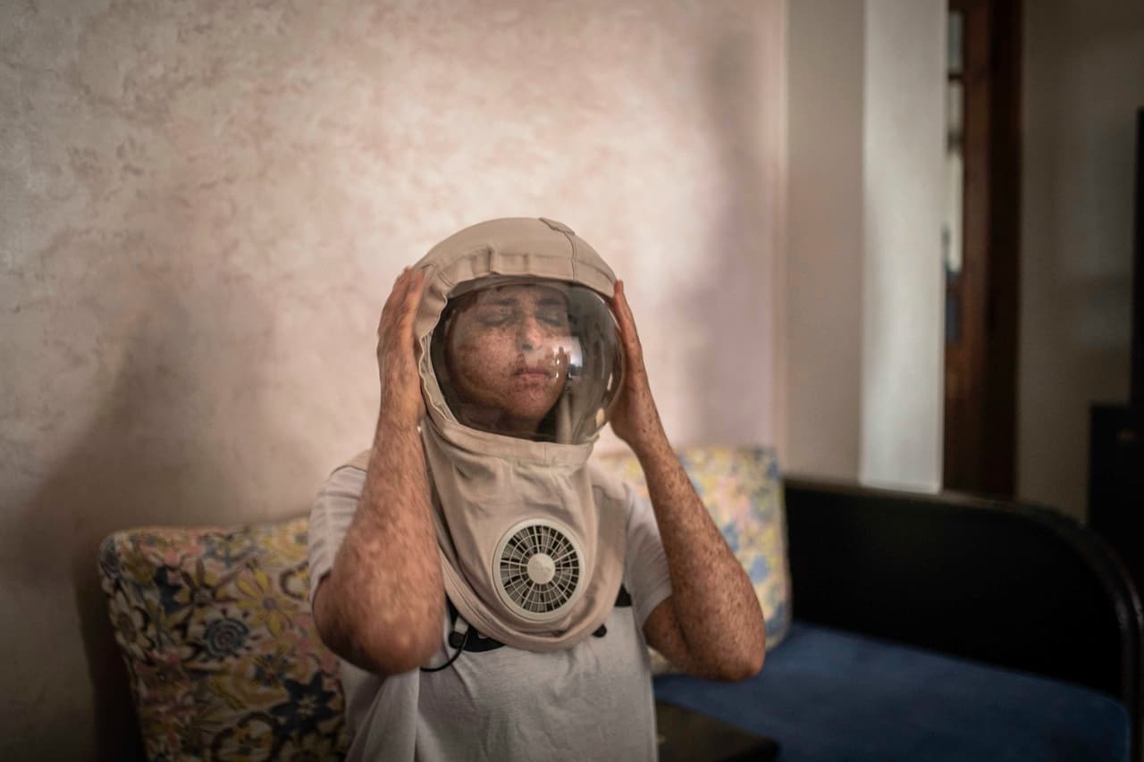 Sin protección, pocos pacientes con XP en Marruecos viven más allá de su adolescencia. Fatimazehra El Ghazaoui, de 27 años, se pone una máscara protectora que usa afuera en días soleados.
<br>