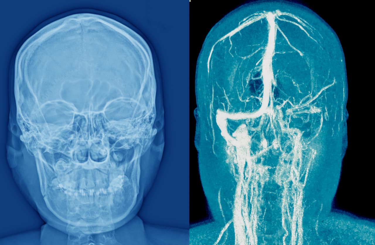<h3 class="cms-H3-H3">7. Efectos tardíos de enfermedad cerebrovascular</h3>
<br>
<br>🏥 
<b>Crecimiento en costo por caso de acuerdo con el Índice de Gastos Médicos: </b>4.95
<br>
<br>🏥 
<b>Aumento del gasto en los últimos 10 años registrados: </b>189.4%