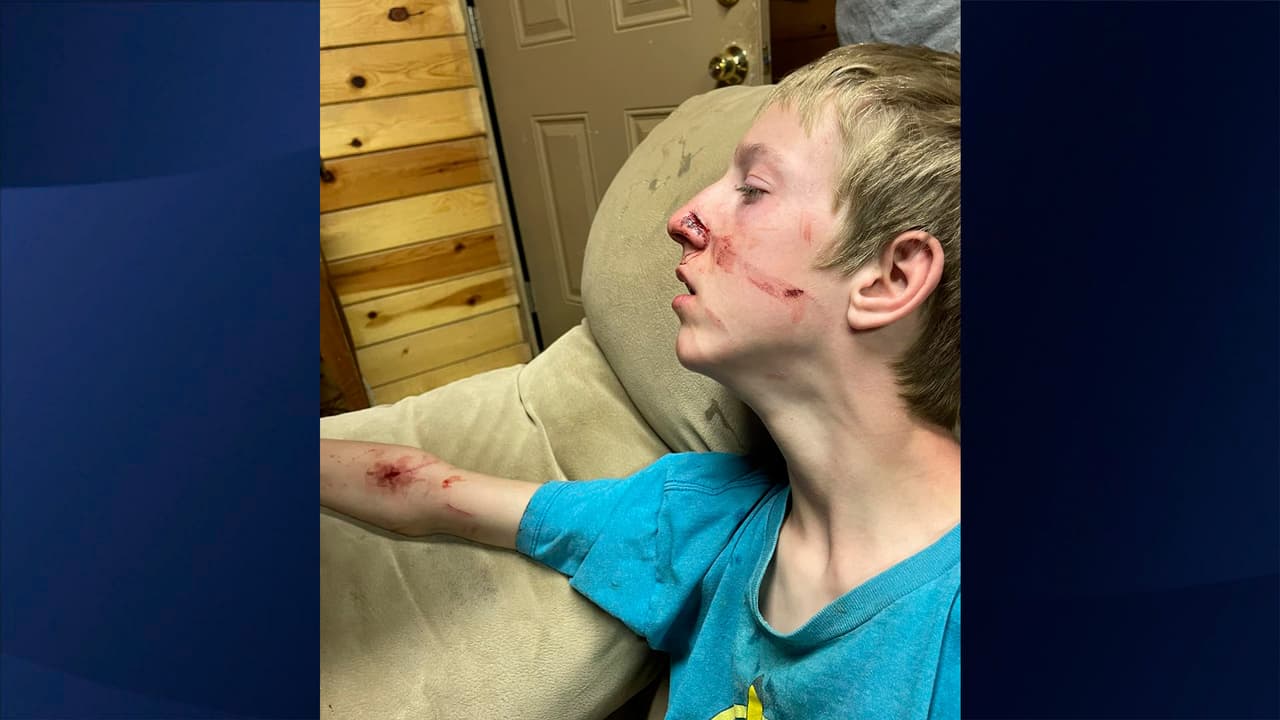 Brigham Hawkins sufrió heridas en el rostro y un brazo