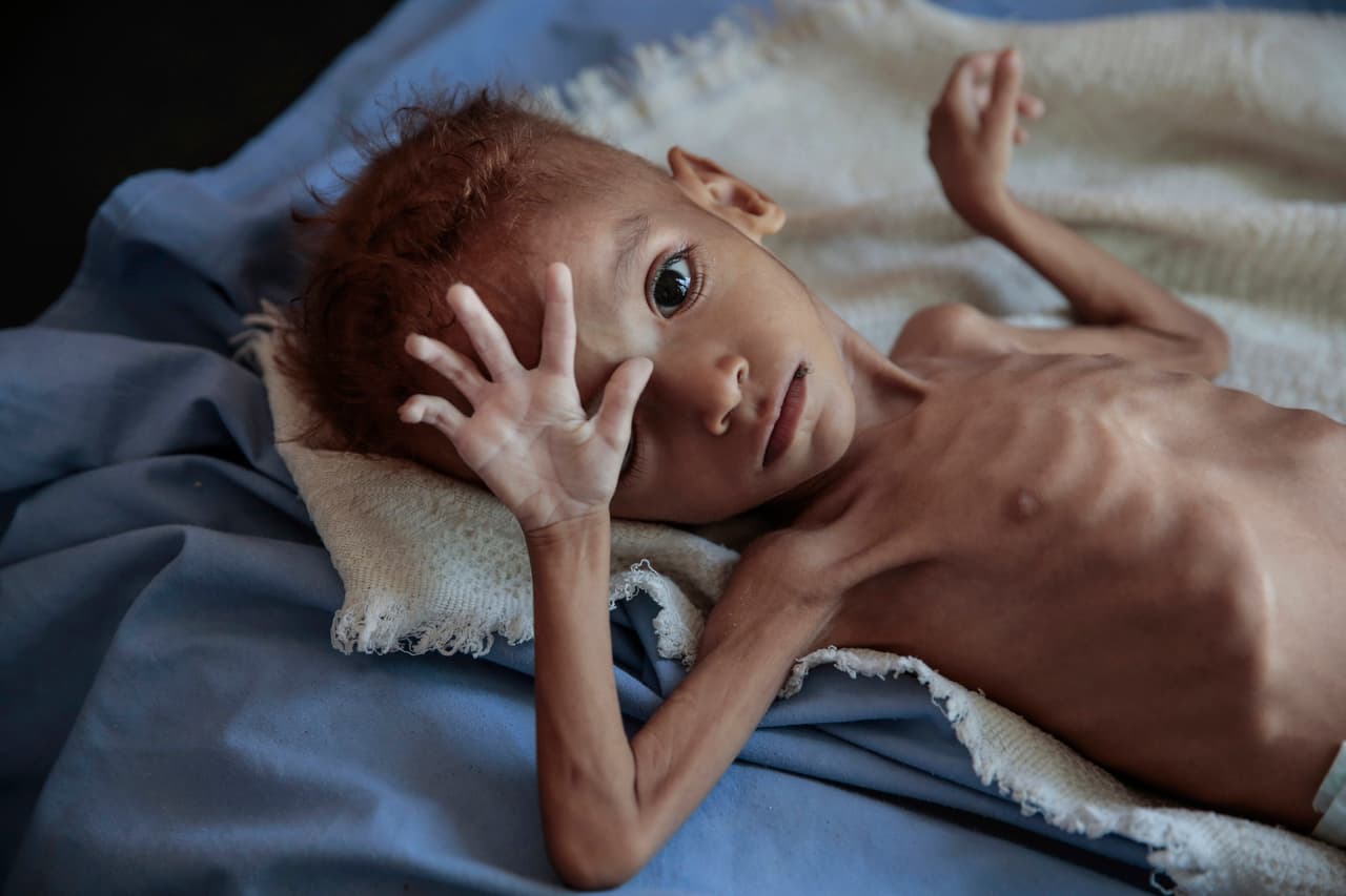 "Haciendo una estimación conservadora, sabemos que 
<b>84,701 niños con desnutrición aguda grave podrían haber muerto </b>entre abril de 2015 y octubre de 2018", se lee en el comunicado publicado por la ONG. En esta fotografía del 1 de octubre de 2018, un niño gravemente desnutrido descansa en una cama de hospital en el Centro de Salud de Aslam, Hajjah, en Yemen.