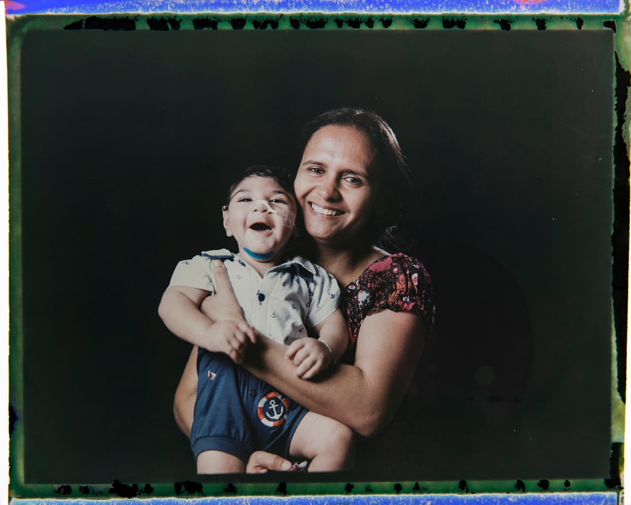 El zika no le arrebató la sonrisa ni a Arthur Conceicao, de 1 año, ni a su madre, Rozeline Ferreira. Como muchos otros, el pequeño nació durante el apogeo del 
<a href="http://www.univision.com/noticias/alarma-en-brasil-por-rapido-incremento-de-recien-nacidos-con-microcefalia-video">número de nacimientos de bebés con microcefalia en Brasil</a>. Un año después, los doctores e investigadores brasileños han diagnosticado a muchos bebés afectados con problemas para tragar, 
<a href="http://www.univision.com/noticias/virus-del-zika/epilepsia-en-recien-nacidos-otro-posible-efecto-del-zika-durante-el-embarazo"><u>ataques epilépticos</u></a> y problemas de visión y auditivos.