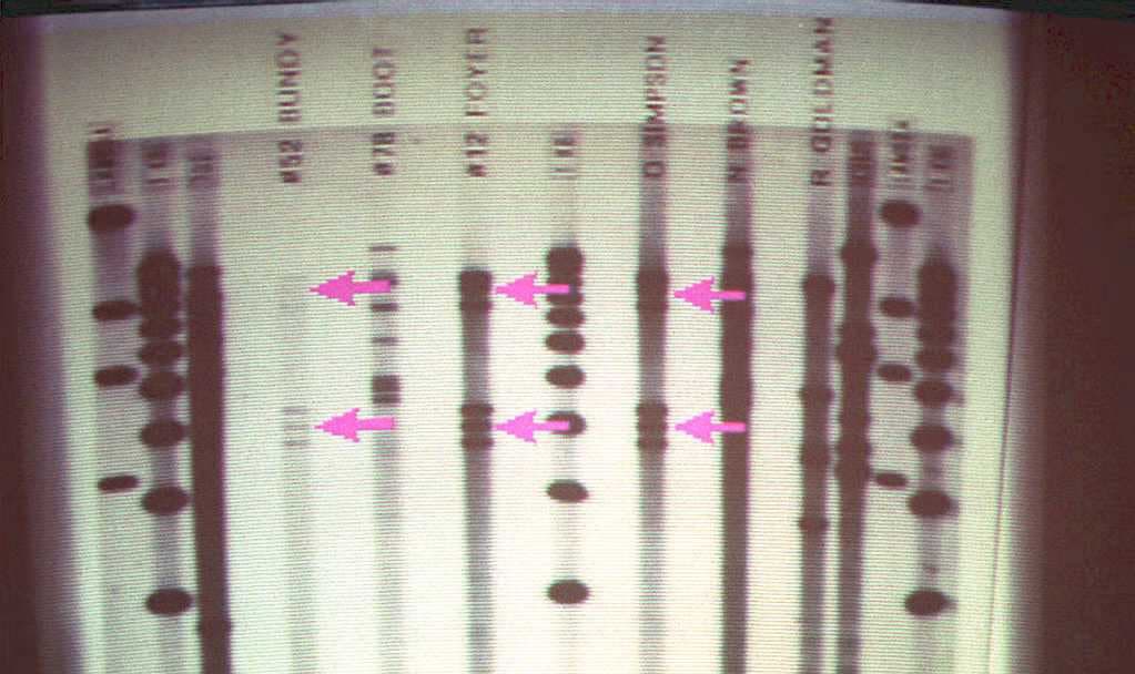 La enfermedad es causada por una 
<a href="https://www.univision.com/temas/enfermedades-congenitas">mutación genética</a> en el cromosoma X que provoca el déficit de las proteínas factor VIII (origina la hemofilia A, la más común) y factor IX (hemofilia B), lo cual 
<b>impide la coagulación adecuada de la sangre</b>.