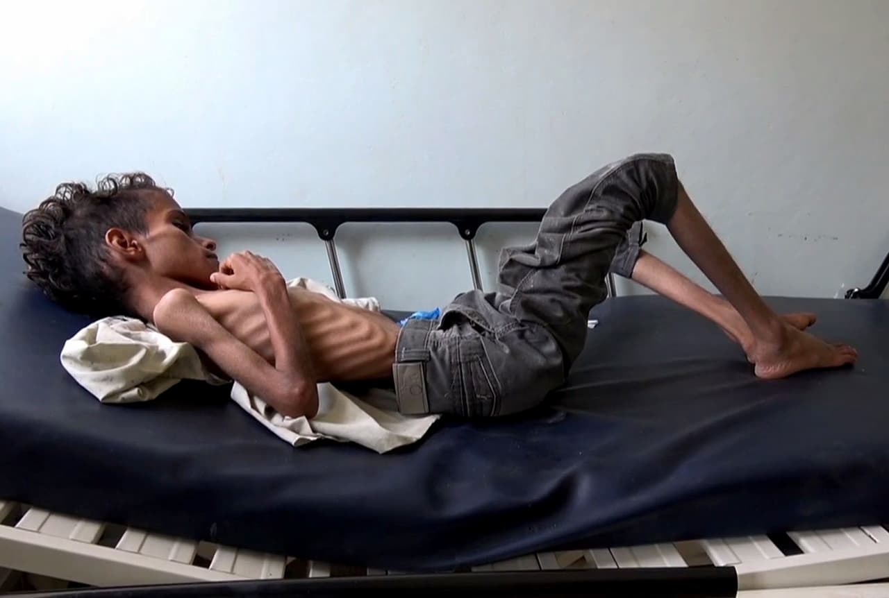 Ghazi Saleh, de 10 años, solo pesa 17 libras (unos 8 kilogramos) y está hospitalizado en Taez, en el suroeste de Yemen. Apenas puede respirar, está demasiado débil para moverse o incluso llorar. La ONU considera que desde que comenzó 
<a href="https://news.un.org/es/story/2018/09/1442262">este conflicto han sido asesinadas al menos 16,000 personas.</a>