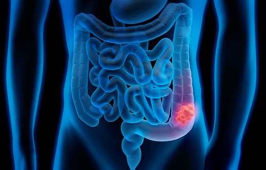 En un cambio de lineamientos, panel de expertos recomienda que el despistaje de cáncer colorrectal comience a los 45 años