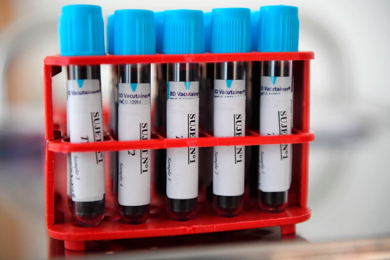 La enfermedad puede detectarse a través de un examen de sangre. Esta prueba determinará el tipo de hemofilia que se tiene y su nivel de gravedad.