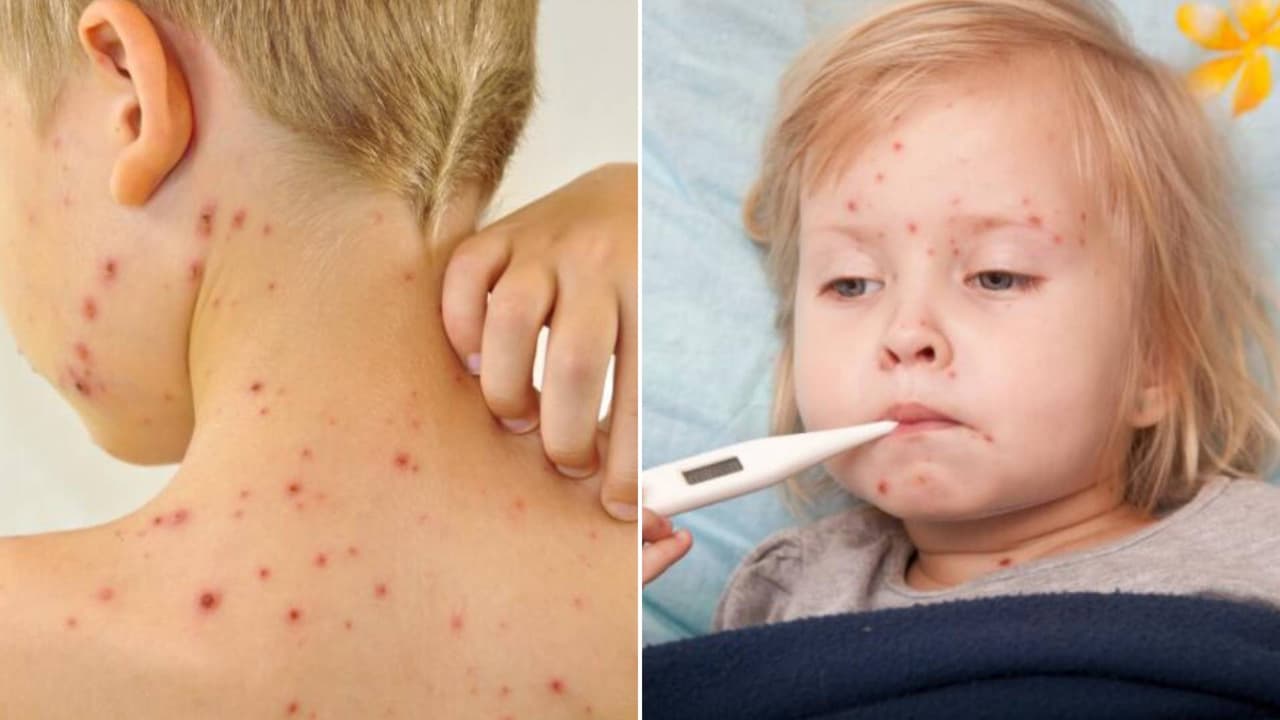 ¿Te puedes contagiar de varicela dos veces? Estas son las señales de alerta