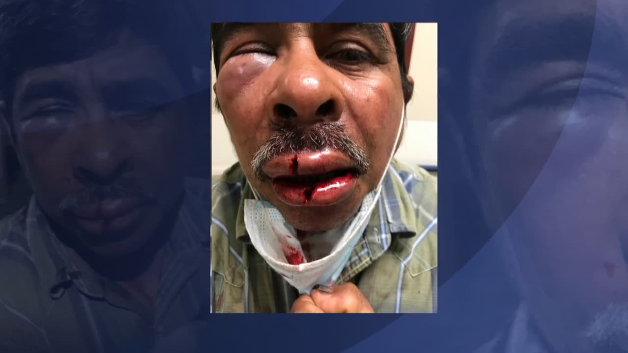Marcelo Labra, un inmigrante de origen mexicano que reside en el área de Kendale Lakes, en el suroeste de Miami-Dade, está denunciando un brutal ataque en su contra, el cual posiblemente estuvo motivado por el odio. 
<br>