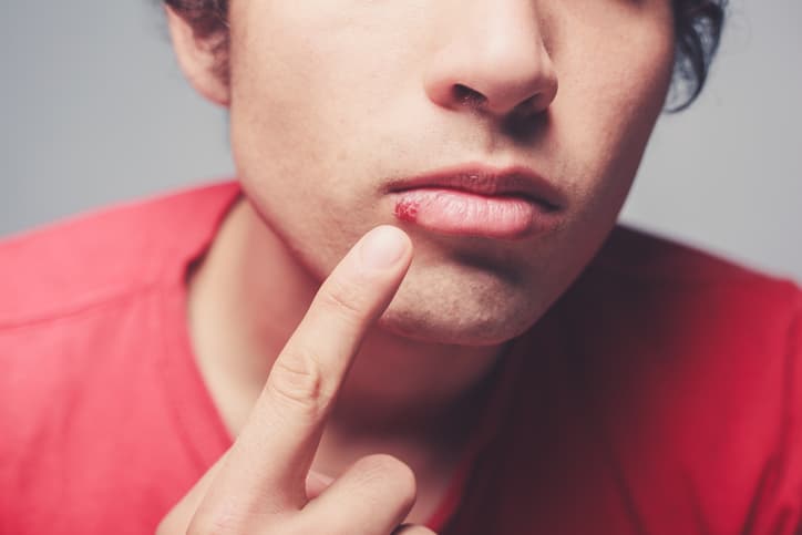 <b>Herpes genital</b>. En EEUU 
<a href="https://www.cdc.gov/std/spanish/herpes/stdfact-herpes-s.htm">una de cada seis personas de entre 14 y 19 años</a> tiene herpes genital. La mayoría no presenta síntomas o son muy leves. Las llagas del herpes por lo general se ven como una o más ampollas en los genitales, el recto o la boca, o a su alrededor. Las ampollas se abren y dejan llagas dolorosas que pueden tardar una semana o más en curarse. A estos síntomas a veces se les conoce como “tener un brote”. La primera vez que una persona tiene un brote es probable que también presente síntomas similares a los de la influenza (gripe).