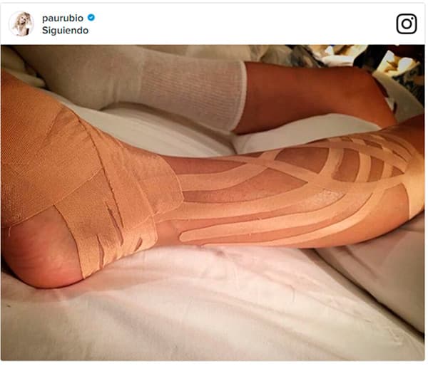 La misma cantante publicó después una foto de su pierna con unas cintas como parte de su recuperación.