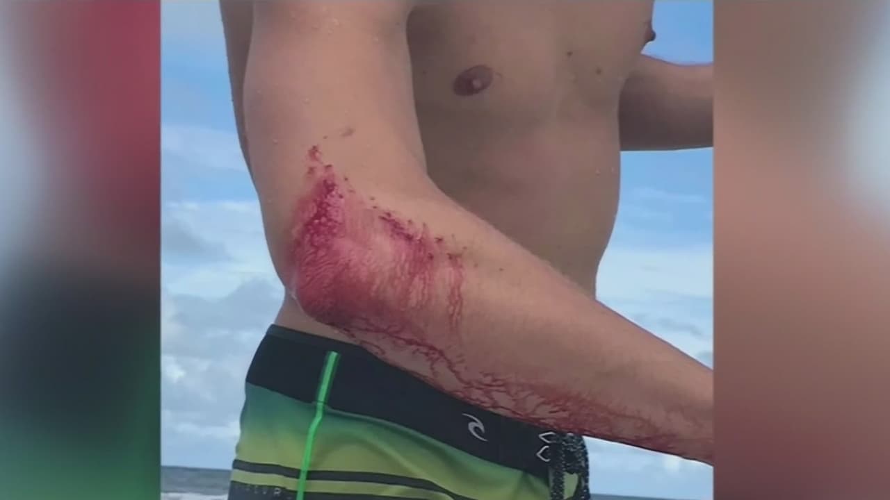 Lo mordió un tiburón en esta playa de Florida pero se quedó en un bar y no fue al hospital 