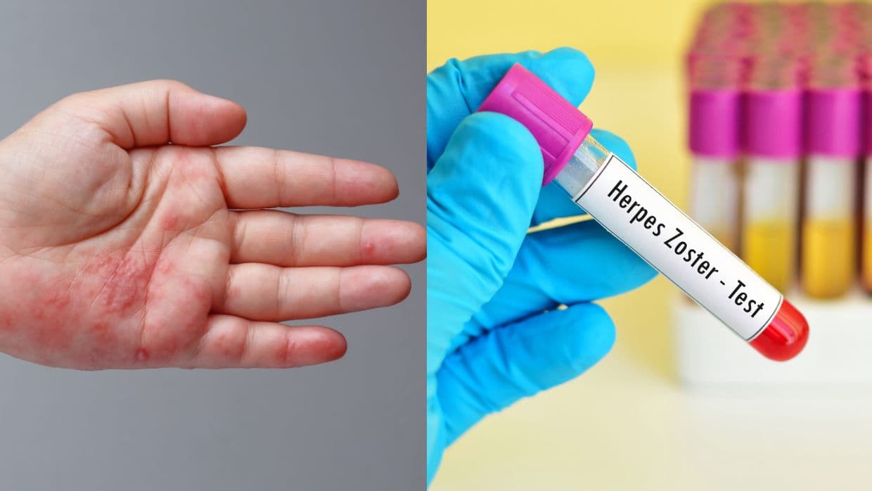 Culebrilla o herpes zóster: una enfermedad común que se activa con el estrés y podría tener consecuencias