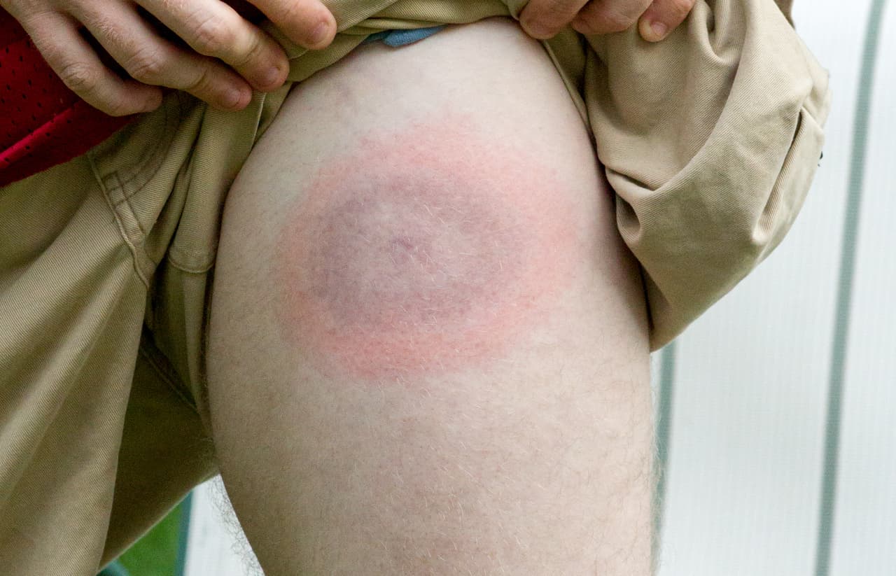 Los síntomas adicionales del virus Powassan pueden incluir vómitos, debilidad, confusión, pérdida de coordinación, dificultad para hablar o incluso convulsiones en casos graves. Mientras que la transmisión de la enfermedad de Lyme de una garrapata a un ser humano tarda aproximadamente 24 horas o más, la transmisión de Powassan por una picadura de garrapata puede ocurrir en tan solo 15 minutos. Si tiene síntomas que son consistentes con una enfermedad transmitida por garrapatas, es importante hablar con un médico de inmediato.