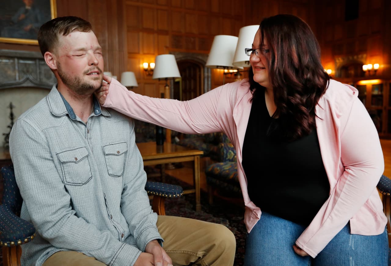 El encuentro a fines de octubre fue en la Clínica Mayo, Minnesota, institución que realizó la operación de 56 horas. La historia relatada por la agencia AP, cuenta que Lilly Ross extendió su brazo y tocó y palpó el rostro Sandness, que antes era de su esposo.