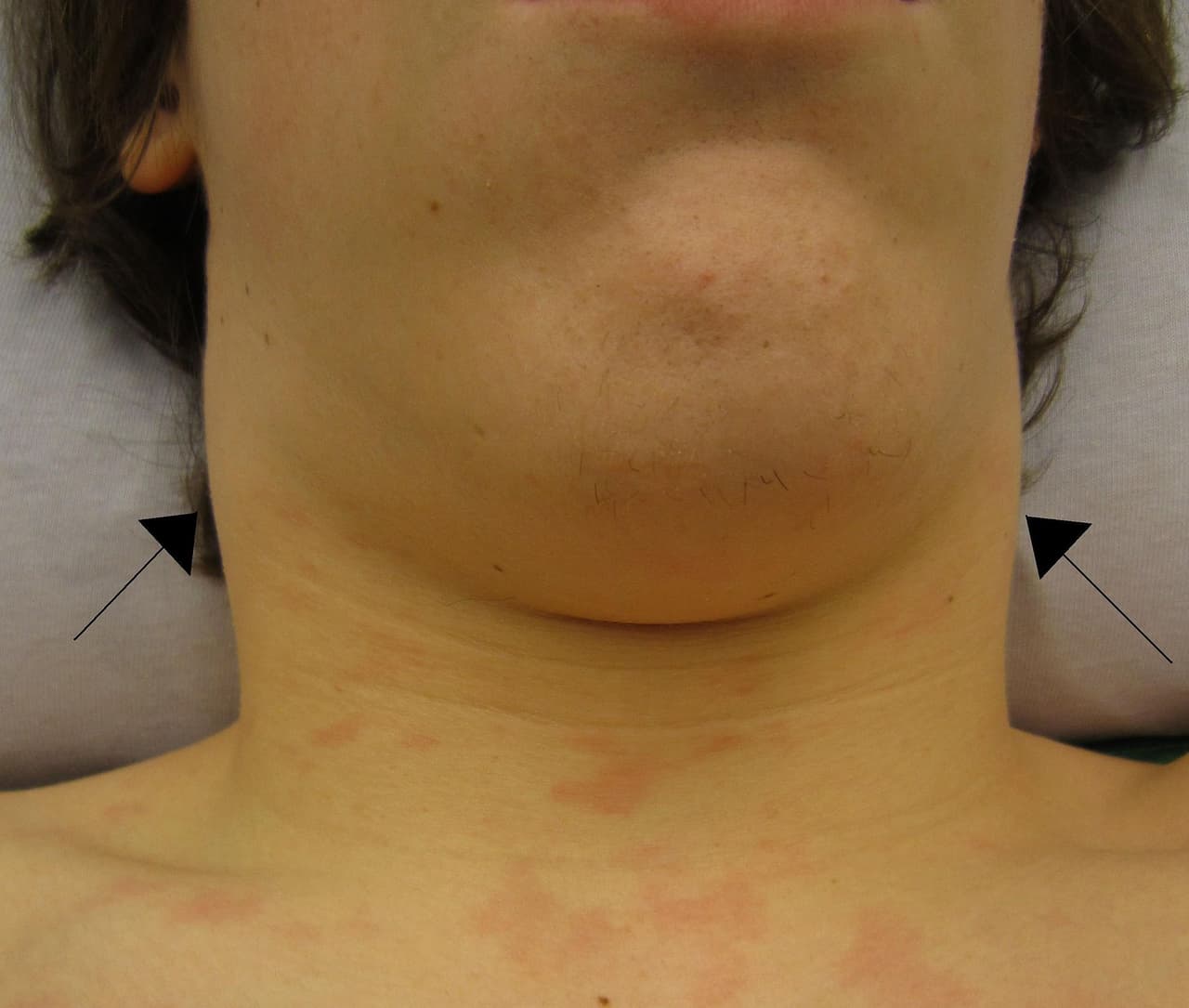 <b>Mononucleosis:</b>
<br>Conocida como la enfermedad "mono" o la "enfermedad del beso" ya que su vía principal de transmisión es la saliva. Los síntomas que la caracterizan son fiebre, faringitis o dolor de garganta, inflamación de los linfonodos y fatiga.