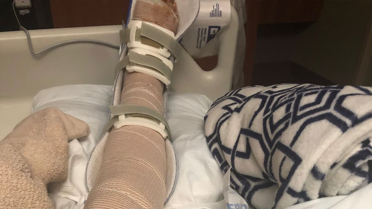 "Por dentro es un dolor muscular intenso y por fuera es un ardor tremendo. Se siente que te quemen en vida" le dijo esta madre de cuatro hijos a 
<a href="https://www.univision.com/local/houston-kxln/">Univision 45</a>.