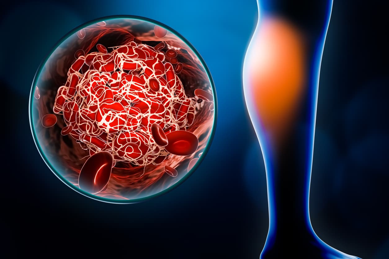 Los investigadores 
<a href="https://www.ahajournals.org/doi/10.1161/circgenetics.116.001651" target="_blank">estudian</a> la relación entre 
<b>la estatura y el tromboembolismo venoso,</b> la tercera causa de infarto de miocardio e ictus. Comprobaron que, en un grupo de más de 2 millones de hermanos suecos, los hombres de menor estatura tenían menor de desarrollar un tromboembolismo venoso, un tipo de coágulo sanguíneo que se origina en una vena, que los hombres de estatura superior. La gravedad podría tener que ver, pero son necesarios más estudios para confirmar estas especulaciones.
<br>