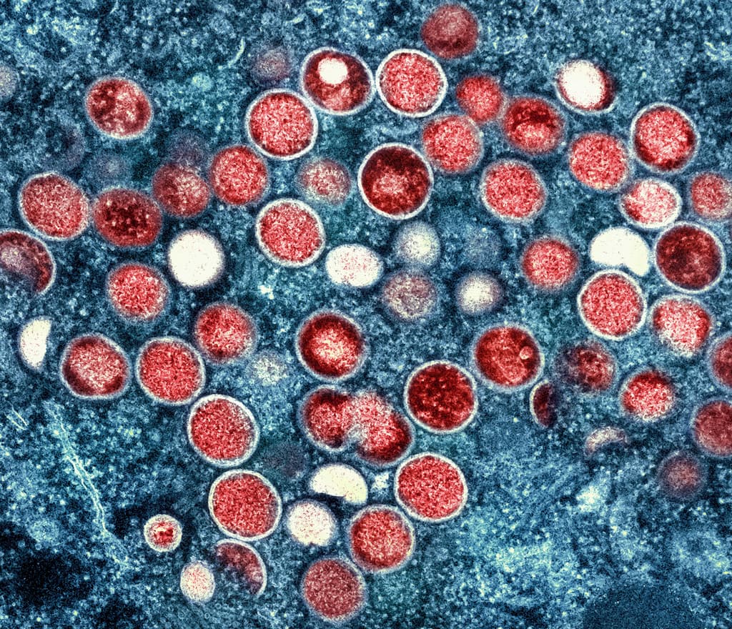 Reportan el primer caso de viruela del mono fuera de África: qué protección tienen los ya vacunados 