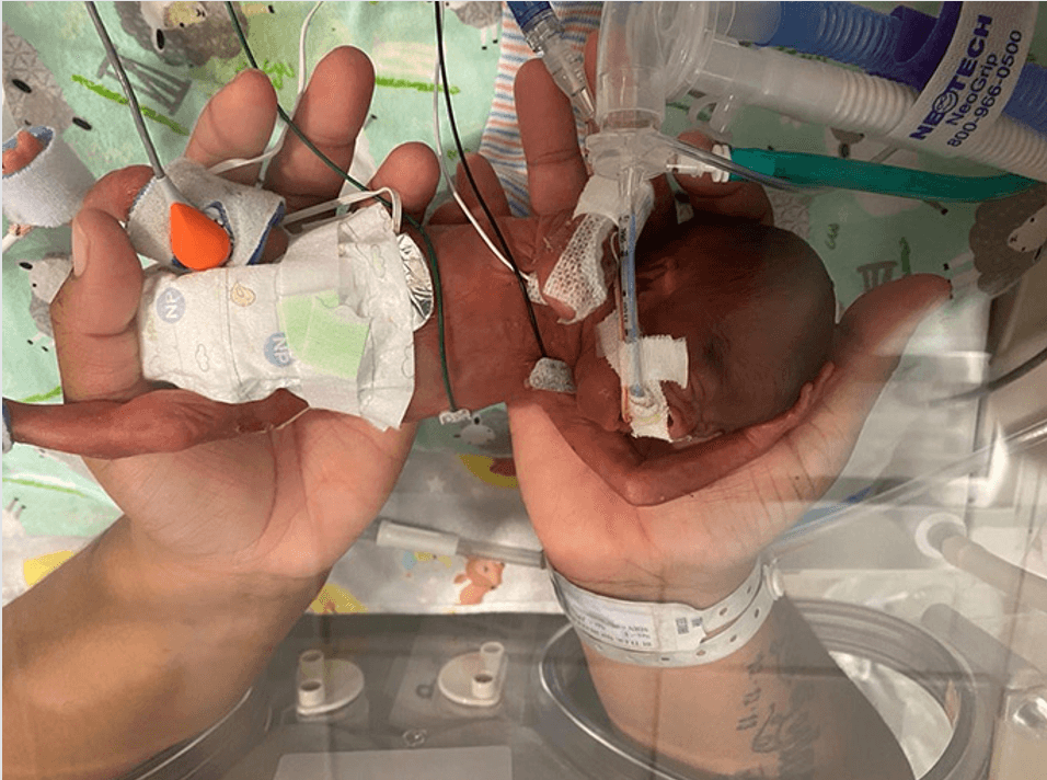 Al momento de nacer, 
<a href="https://www.univision.com/temas/bebes">el bebé</a> Curtis Means pesó el equivalente a dos manzanas grandes. Pesó apenas 14,8 onzas (420 gramos) cuando su mamá lo dio a luz con apenas 21 semanas y un día de gestación.
