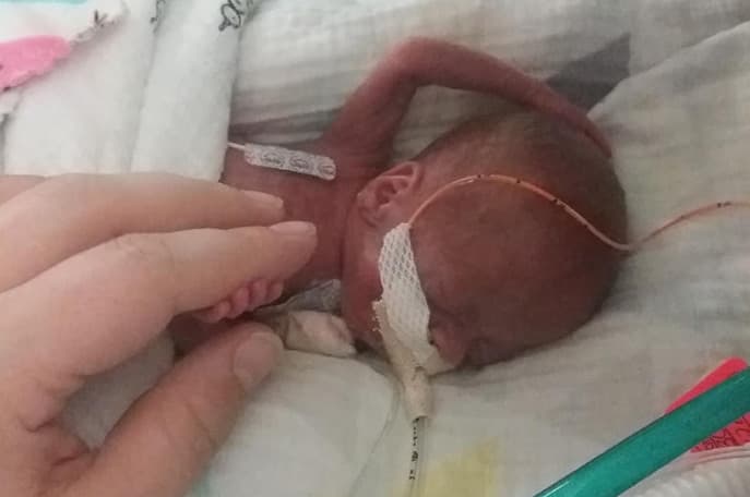 Beth Hutchinson, su madre, sufrió complicaciones médicas justo 
<b>con 21 semanas y 2 días de gestación</b>, cinco meses antes de lo esperado, que le hicieron entrar en trabajo de 
<a href="https://www.univision.com/temas/parto">parto</a>. La mujer fue trasladada al hospital donde el niño nació con apenas el peso de una lata de sopa y sus padres podían sostenerlo en la palma de su mano.