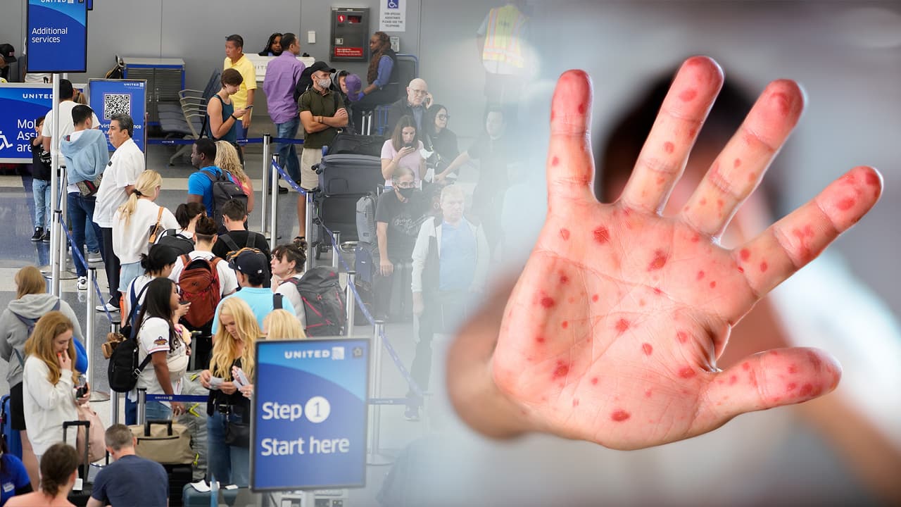 ¿Qué hacer en caso de exponerse a una persona contagiada con sarampión? Estos son los síntomas