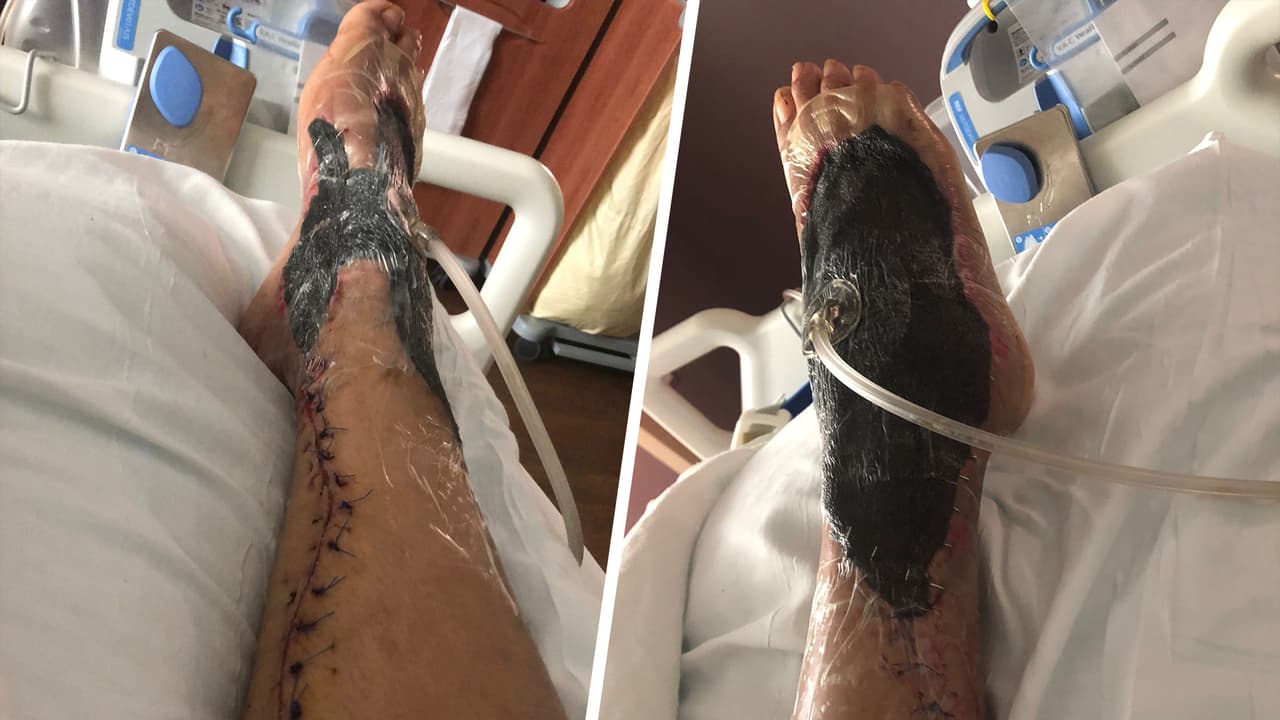 <a href="https://www.univision.com/local/houston-kxln/lou-huerta-habla-sobre-como-se-contagio-con-la-bacteria-come-carne-en-houston-video">Lou Brigitte Huerta, de 35 años, </a>se contagió de la bacteria 'come carne' y casi pierde su pie tras la picada de una jaiba.