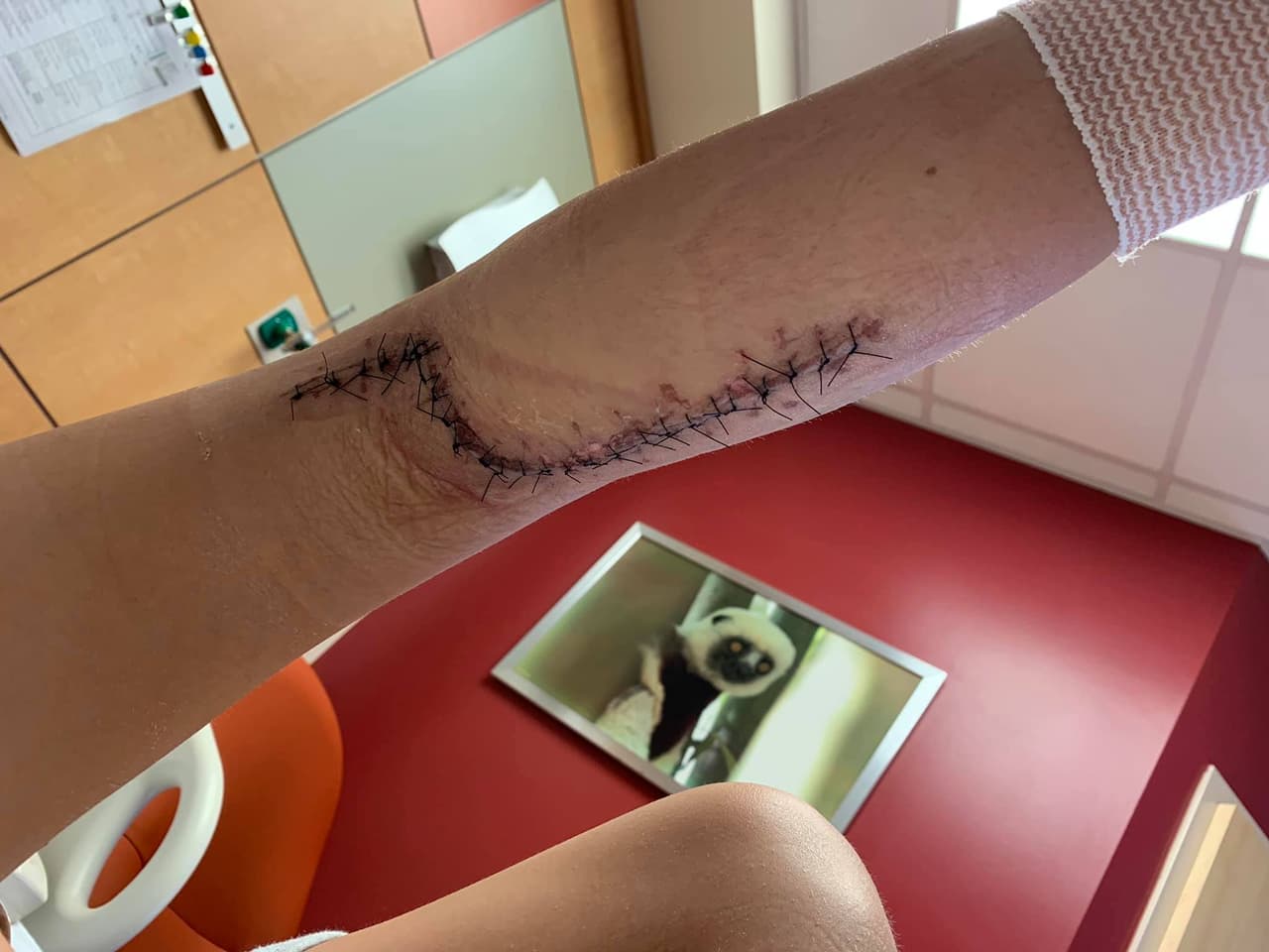 “Le dije a mi madre varias veces que solo quiero volver a ser normal con mi pierna”, dijo Kylei.
