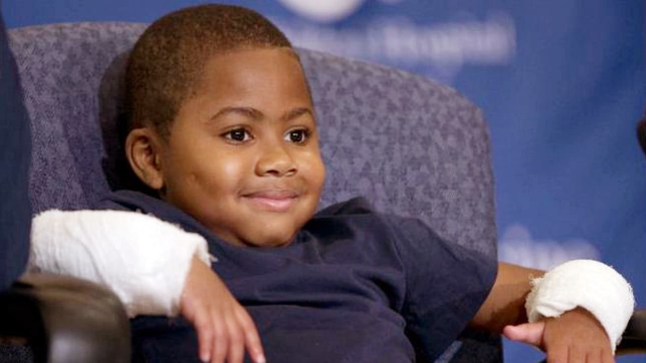 Hito científico: por primera vez un niño de 8 años recibe un doble transplante de manos