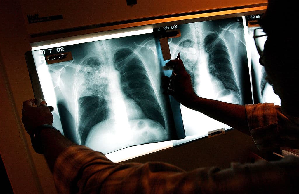 <b>Puesto 13. Tuberculosis: 2.1%.</b> 1,180,000 muertes en 2017.
