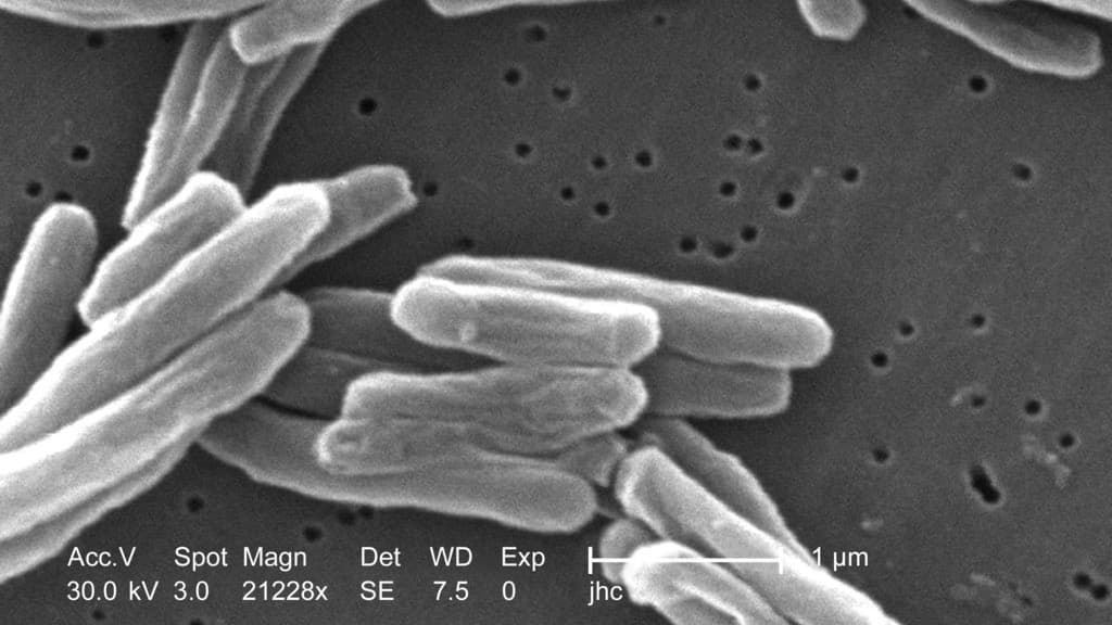 Este estado afirma que enfrenta el brote de tuberculosis más grande en la historia de EEUU; los CDC lo niegan