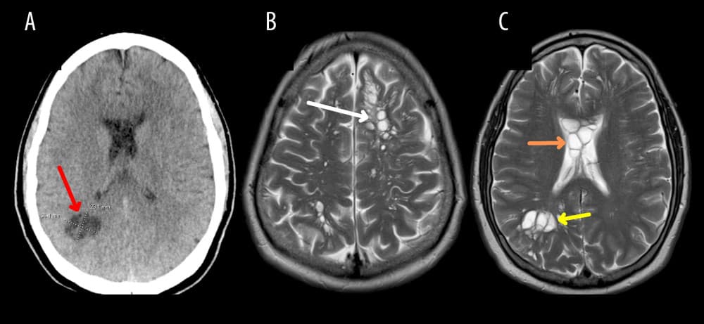 Qué es la neurocisticercosis: la infección con la que pueden nacer gusanos en el cerebro
