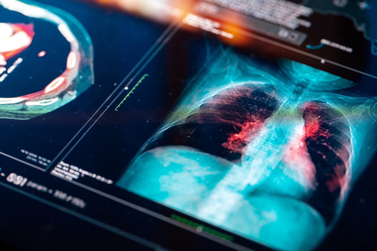 La inteligencia artificial podría detectar el cáncer de pulmón antes que las tomografías, señalan expertos
