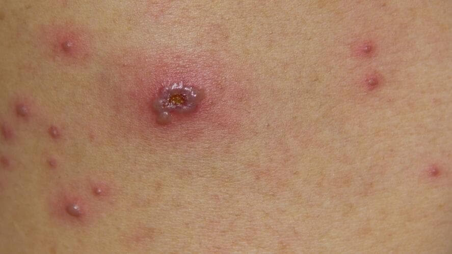 Además de las ampollas en la piel la viruela del mono tiene otros síntomas como fiebre y dolor de cabeza.