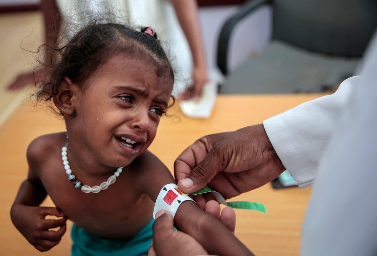 Un médico mide el brazo de una niña desnutrida en un hospital de Hajjah, Yemen, el 1 de octubre de 2018. “Por cada niño muerto por bombas y balas, decenas están muriendo de hambre y enfermedades y es completamente evitable", asegura la organización Save the Children.