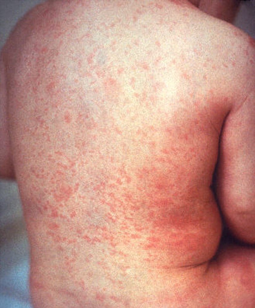 Una erupción de rubéola, una enfermedad infecciosa, contagiosa y epidémica, en la espalda de un niño (1978).