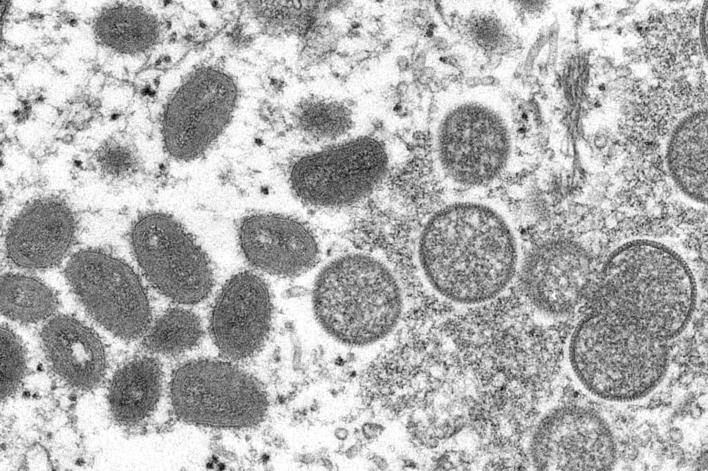 <b><a href="https://www.univision.com/noticias/salud/que-es-la-viruela-del-mono-primer-caso-eeuu">Primer caso de viruela del mono en Estados Unidos </a></b>
<br>
<br>Autoridades sanitarias en Massachusetts confirmaron el 19 de mayo que uno de sus residentes había arrojado una prueba positiva por viruela del mono, convirtiéndose en el primer caso registrado en el país. Los funcionarios de salud indicaron en un comunicado que el paciente estaba hospitalizado “y en buenas condiciones”, por lo que no representaba “ningún riesgo para el público. 
<br>Autoridades sanitarias en Massachusetts confirmaron el 19 de mayo que uno de sus residentes había arrojado una prueba positiva por viruela del mono, convirtiéndose en el primer caso registrado en el país. Los funcionarios de salud indicaron en un comunicado que el paciente estaba hospitalizado “y en buenas condiciones”, por lo que no representaba “ningún riesgo para el público. 
<br>