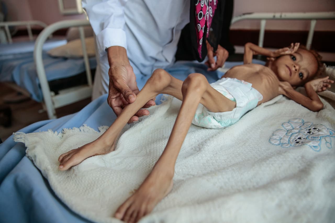 La organización Save the Children ha proporcionado alimentos a 
<b>140,000 niños y tratado a más de 78,000 con desnutrición</b>, lo que no ha sido suficiente para detener la tragedia. Los pequeños además se han visto afectados por enfermedades como el cólera y la difteria.