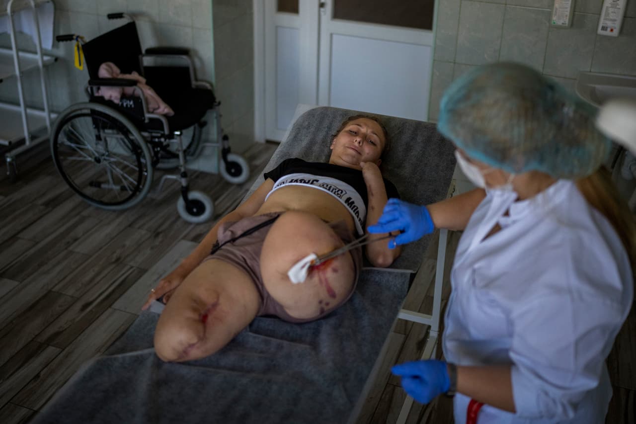 En la foto: Oksana Balandina, de 23 años, recibe asistencia médica en un hospital público en Leópolis. Oksana perdió ambas piernas y cuatro dedos en su brazo izquierdo cuando un proyectil explotó cerca de su casa. 
<b>"Hubo una explosión. Justo después de eso sentí que mis piernas caían al vacío. Estaba tratando de mirar alrededor y vi que ya no había piernas, solo huesos, carne y sangre". </b>