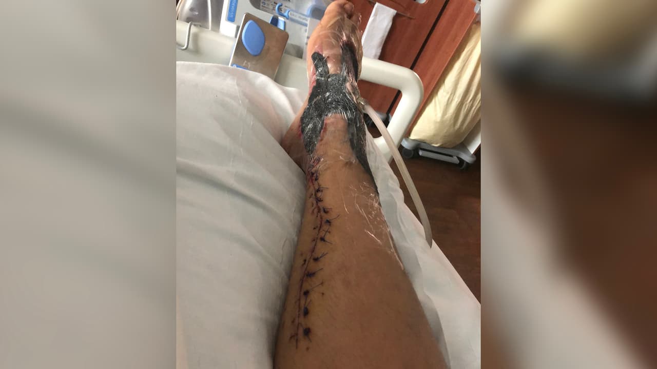 Lou fue enviada al 
<a href="https://www.utmbhealth.com/" target="_blank">Centro Médico de la Universidad de Texas en Galveston (UTMB)</a> donde la operaron de emergencia y luego tuvo que ser intervenida cuatro veces más. "Me dijo el doctor que era afortunada de no perder el pie porque la mayoría de estos casos es amputacion" dijo.