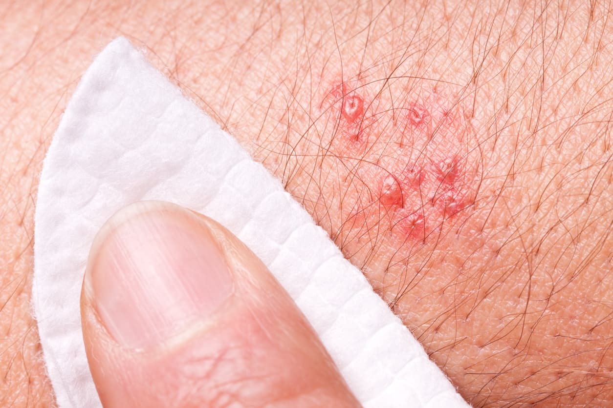 <b>¿Cuáles son sus síntomas?</b> El principal es una erupción que aparece entre un día y dos semanas después de la reactivación del virus, un dolor punzante, hormigueo, picazón y pequeñas ampollas. Puede haber fiebre, cefaleas y sensibilidad en la zona afectada. En algunos casos, 
<b><a href="https://www.cdc.gov/spanish/especialescdc/culebrilla/index.html">el dolor puede llegar a ser tan extremo como el de parto</a></b>.