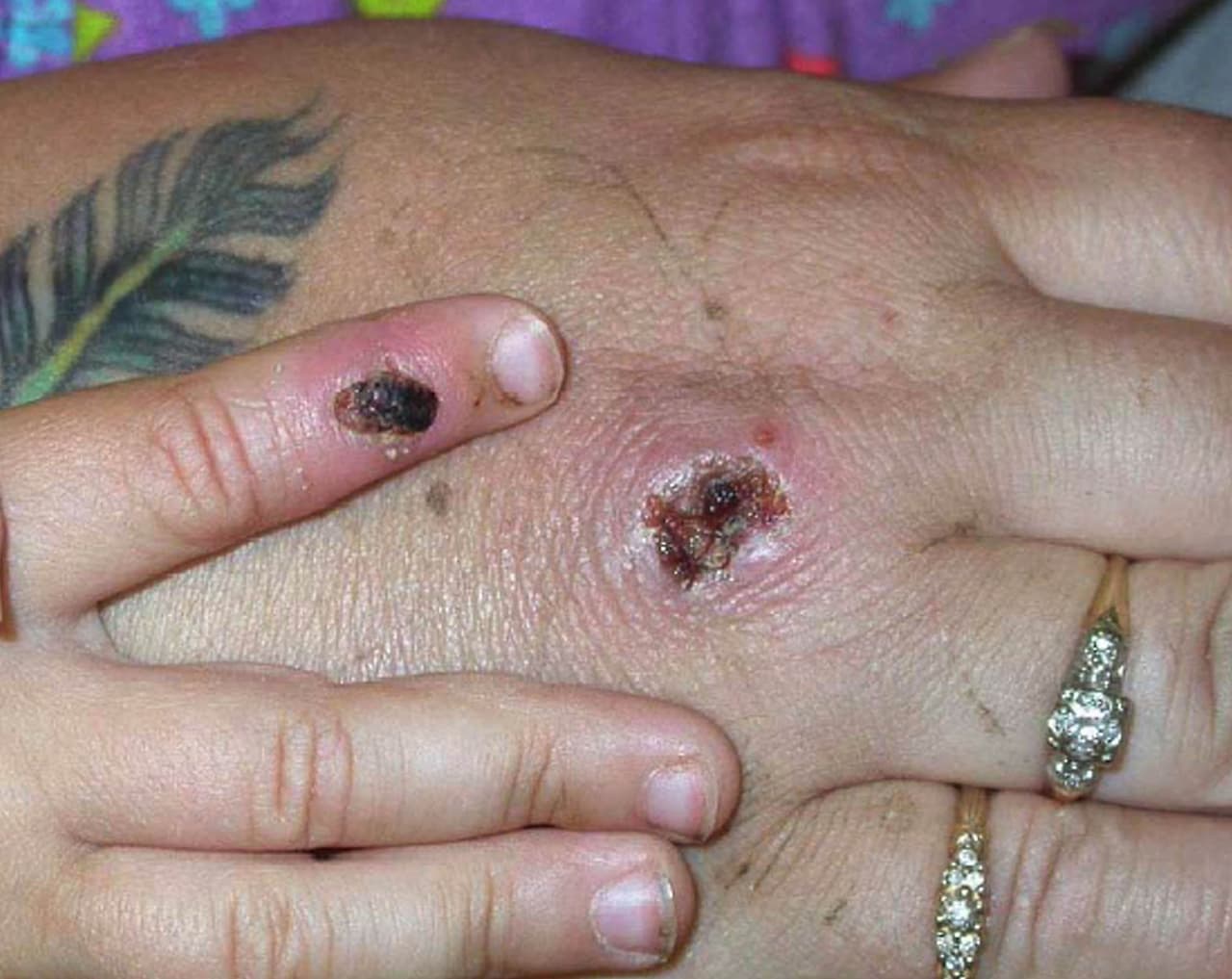 <a href="https://www.who.int/es/news-room/fact-sheets/detail/monkeypox" target="_blank">La OMS también indica que, aunque no hay un tratamiento o vacuna</a> para esta enfermedad, la vacunación contra la viruela ha resultado eficaz para prevenir la viruela símica. 
<br>
<br>