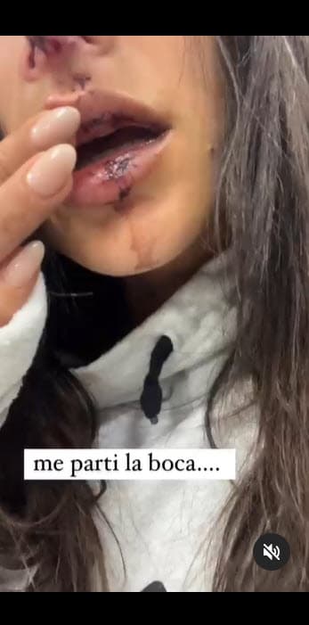 <b>"Me partí la boca…"</b>, continuó. 
<br>