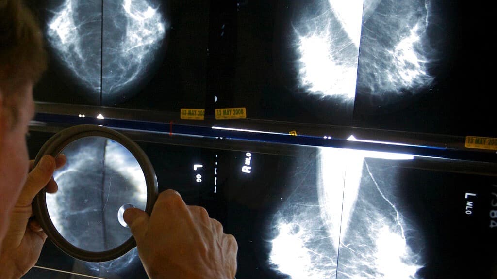 ¿Vacuna contra el cáncer de mama más letal? Sí, y podría estar a la vuelta de la esquina