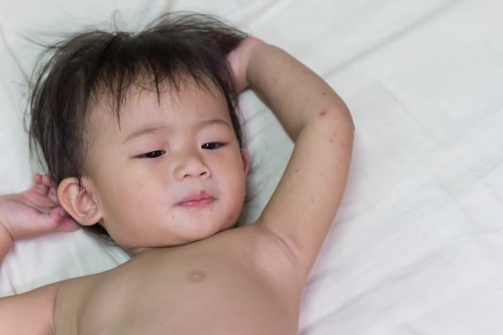 La enfermedad de manos, pies y boca (HFMD por sus siglas en inglés y también conocida como Coxsackie virus) es muy común en bebés y niños pequeños (habitualmente menores de 3 años) que todavía no tienen inmunidad contra los virus que la causan. 
<br>